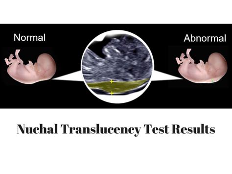 nuchal translucency test results